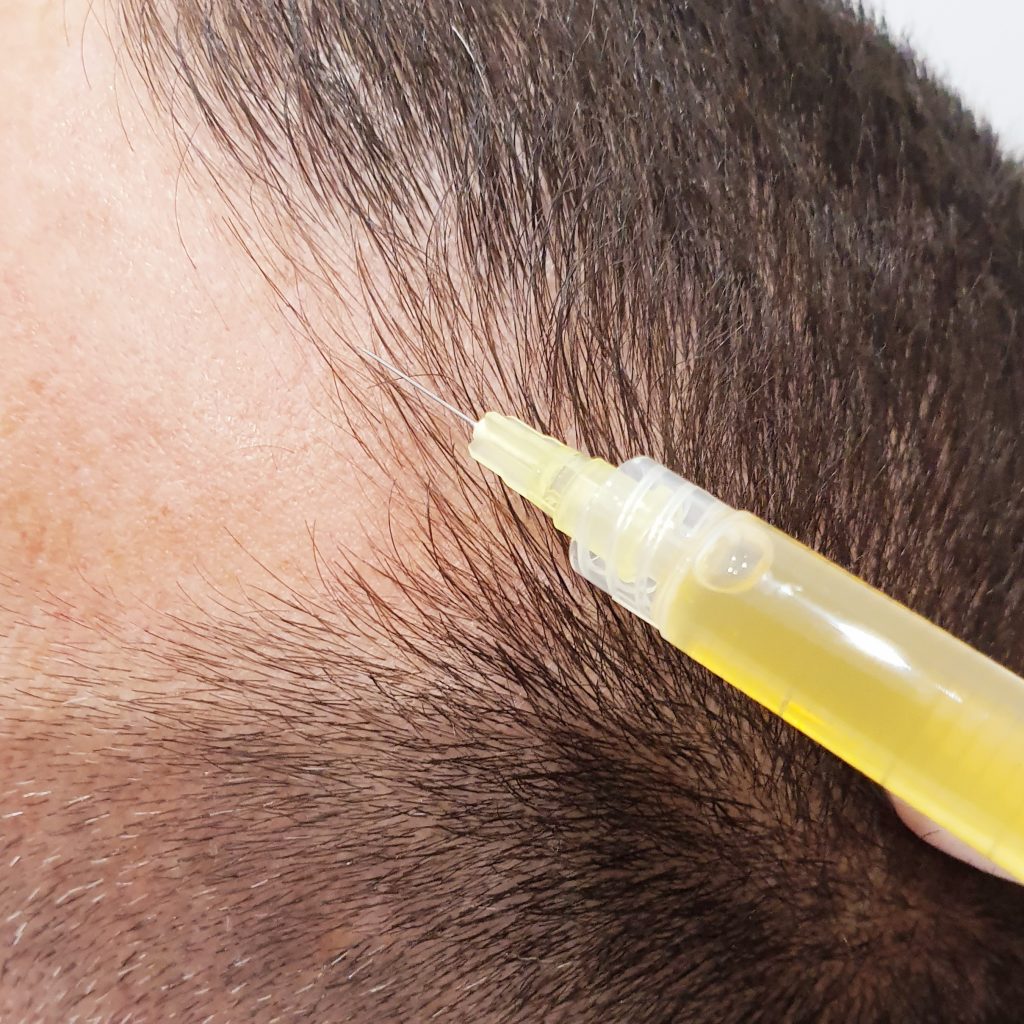 PRP hair regrowth